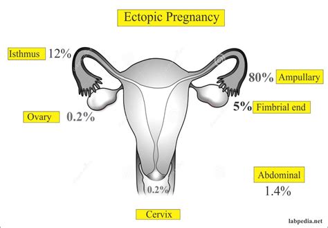 Ectopic Pregnancy And Its Diagnosis