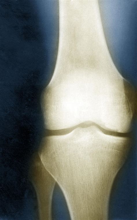 Normal Knee X Ray Photograph By Science Source Fine Art America