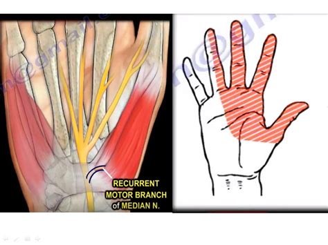 Ganglion Cyst In The Carpal Tunnel —