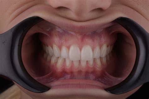 One Side Cheek Retractor Autoclavable Black Dental Market
