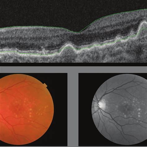 Dry Form Geographic Atrophy Of Age Related Macular Degeneration