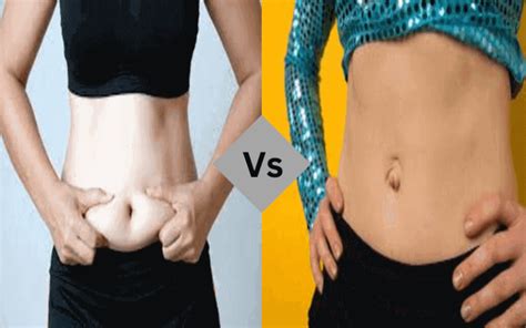 Diastasis Recti And Umbilical Hernia Best 10 Difference A Blog With A