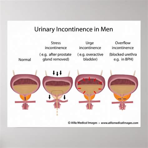 Types Of Urinary Incontinence The Impact Of Urinary Incontinence On