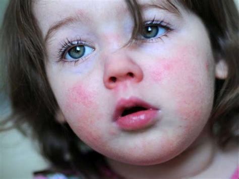 Scarlattina: sintomi e foto per riconoscerla - Passione Mamma