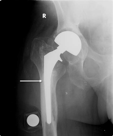 Radiograph Of The Primary Implant Reveal A Mid Stem Fracture