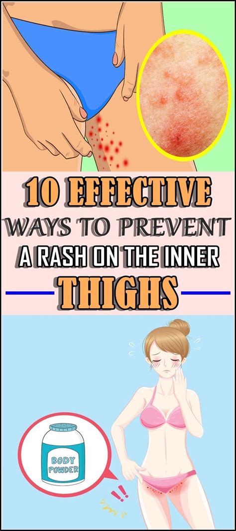 10 Effective Ways To Prevent A Rash On The Inner Thighs Chafed Skin