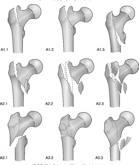 Figure 1 From Do Thoraco Lumbar Spinal Injuries Classification Systems