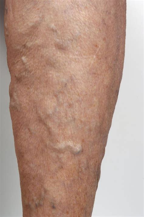 Varicose Veins In The Leg Of A Woman Stock Photo Image Of Deformed