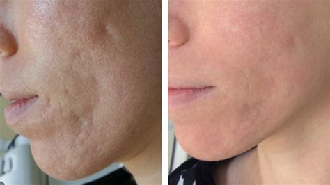 Laser Acne Scar Removal Does It Work Metro Dermatology Vlrengbr