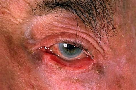 Eyelid Problems Nidirect