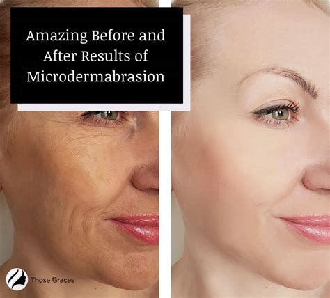 5 Before And After Microdermabrasion Stunning Results Videos
