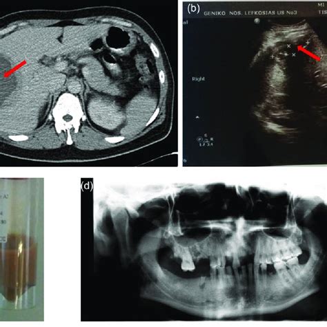 A Abdominal Ct Scan With Intravenous Contrast Showing A Sizable Cyst