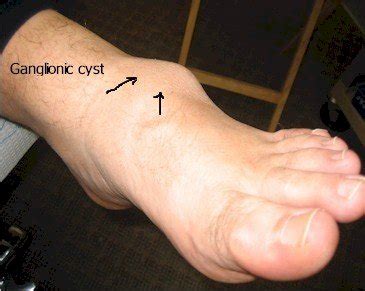 Ganglionic Cysts Of The Foot Causes And Treatment Options