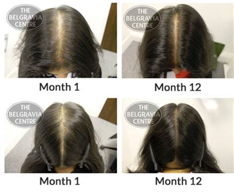 I have learned a thing or two when it comes to various ways to manage very thin, stringy, and even sparse thinning tresses! Does Rogaine work for women? - powerpointban.web.fc2.com