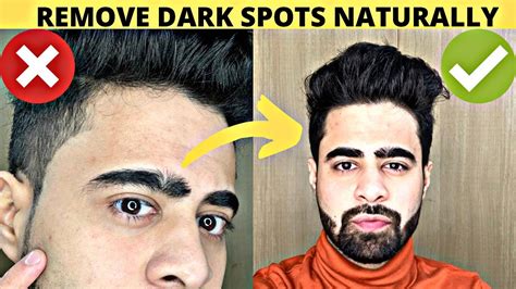 Well, you may go to a dermatologist and seek some medications. REMOVE DARK SPOTS NATURALLY| HOW TO FIGHT ...