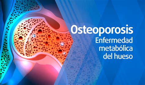 Osteoporosis Dr José Luis Vázquez