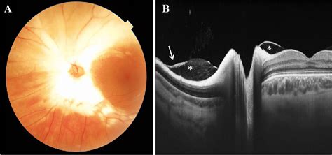 Swept Source Optical Coherence Tomography Of A Vitreal Pocket Entrapped