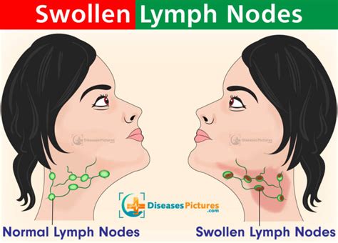 Swollen Lymph Nodes Symptoms Causes In Neck In Groin Treatment Healthmd