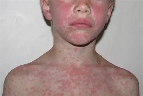 Amoxicillin Allergic Rash Symptoms And Treatment