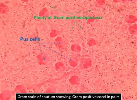 Gram Stain Of Sputum Showing Gram Positive Cocci In Pairs Possible