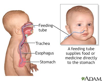 Feeding Tube Infants Information Mount Sinai New York