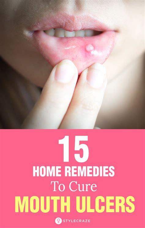 Home Remedies For Mouth Ulcer 15 Natural Remedies To Try At Home