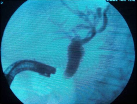 Repeat Ercp Through Minor Papilla Was Later Successful Which Shows Hook