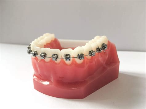 Self Ligating Braces Manchester Orthodontics