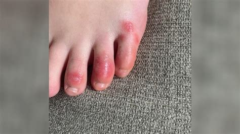 ‘covid Toes Puzzling Condition A Possible Coronavirus Symptom In