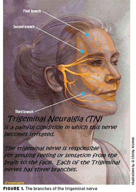 Pin On Trigeminal Neuralgia And Tmj