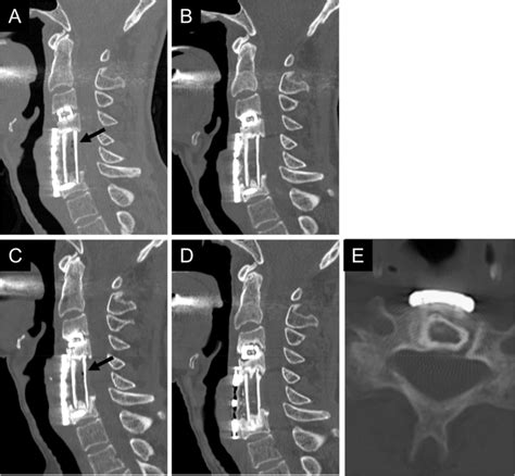 A 71 Year Old Woman Underwent Anterior Cervical Corpectomy And Fusion