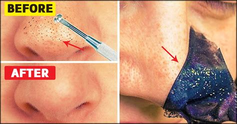 How To Remove Blackheads At Home 12 Natural Remedies To Try