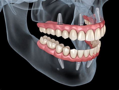 Qué Es Y Cómo Se Realiza La Técnica De Implantes Dentales All On Four
