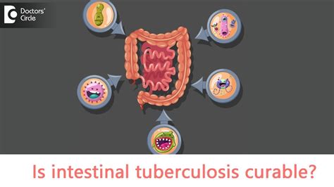Intestinal Tuberculosis Causes Symptoms Is Intestinal Tb