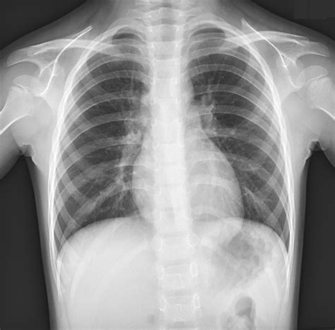 Normal Anatomy Of Chest X Ray Chest Xray Of Normal Healthy Man Show