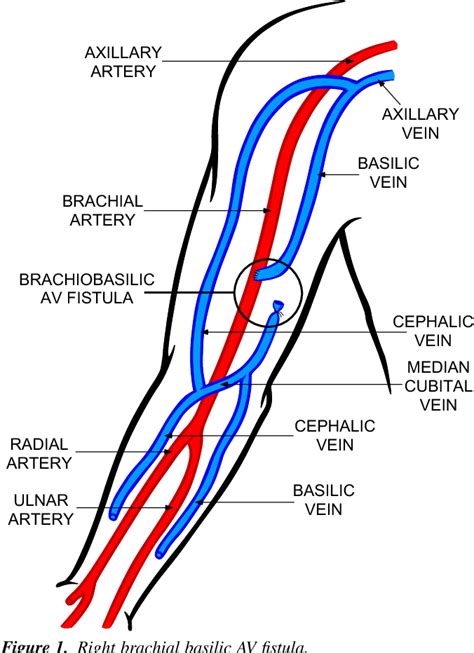 Figure 1 From Axillary Artery Brachial Artery Radial Artery Ulnar