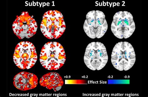 Schizophrenia is a psychiatric disorder characterized by continuous or relapsing episodes of psychosis. Researchers Discover Second Type of Schizophrenia - PR News