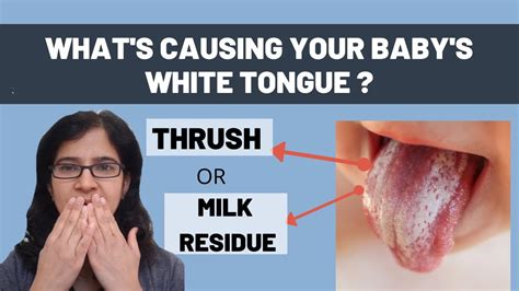 Thrush Or Milk Stain On Tongue I ज़बान पर सफ़ेद दाने White Coating On