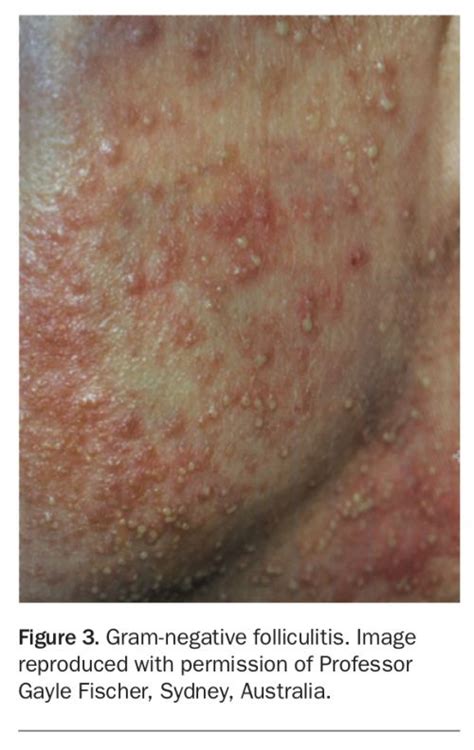 Folliculitis Diagnosis And Management Of Subtypes Medicine Today