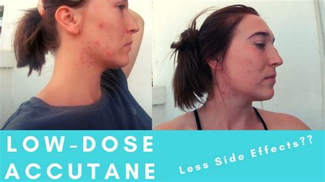 Low Dose Isotretinoin Accutane One Month Progress Effective With