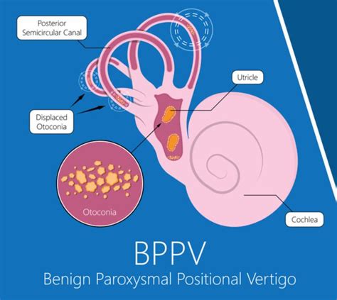 Benign Paroxysmal Positional Vertigo Bppv Symptoms And