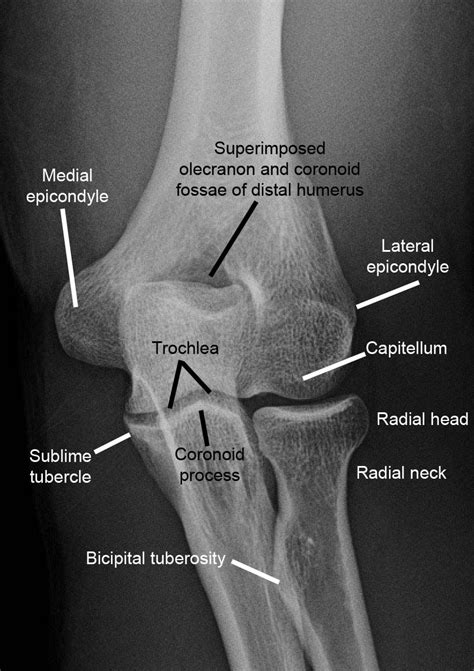 Imaging Of Elbow Fractures And Dislocations In Adults In 2023