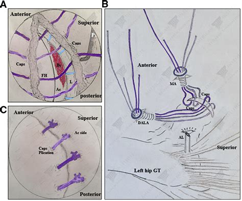 Capsular Management Of The Hip During Arthroscopic Acetabular Chondral