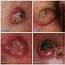 Squamous Cell Carcinoma  Skin Cancer 909