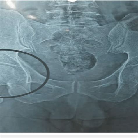 Anteroposterior Pelvic Radiograph Showing Sclerosis Or Cystic