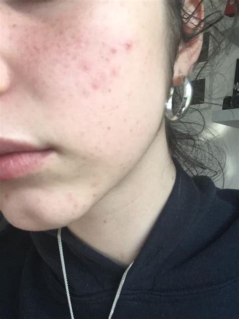 Routine Help What Should I Do To Stop Chin And Cheek Spots The Spots