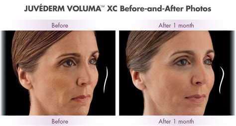 Virginia Beach JuvÉderm® Injections Facial Fillers