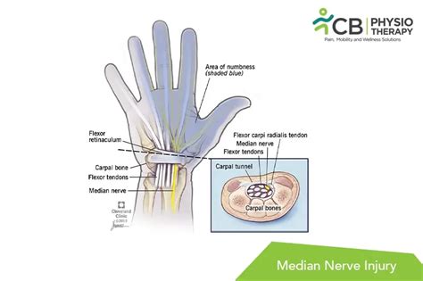 What Is Median Nerve Injury Symptoms Causes Diagnosis