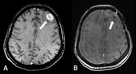 Cureus Preoperative Stereotactic Radiosurgery Of Brain Metastases