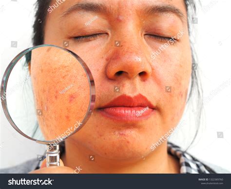 Close Melasma Skin On Woman Face Stock Photo 1322389760 Shutterstock